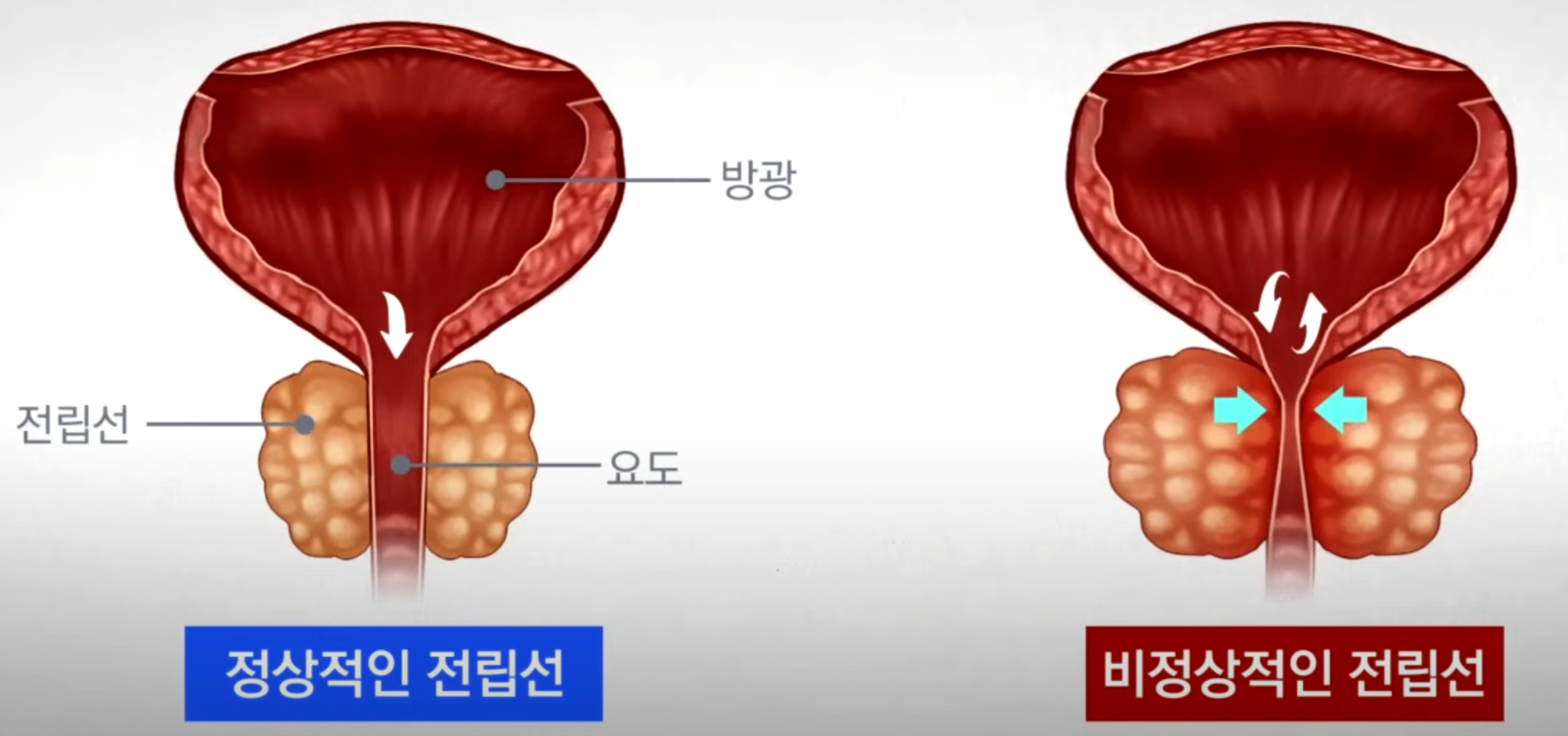 전립선비대증